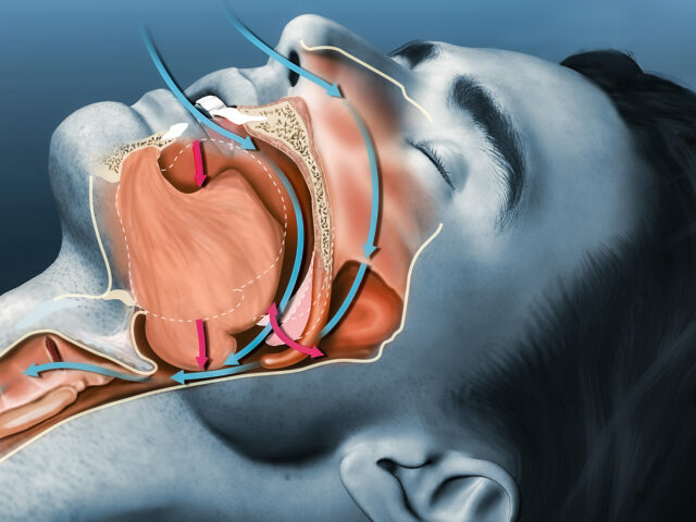 Храп — это просто неудобство или риск апноэ?