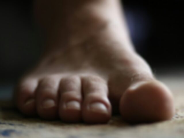 Плоскостопие у взрослых: чем опасно и как лечить?